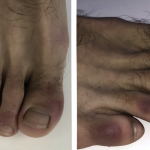 “COVID toes” may be coronavirus symptom