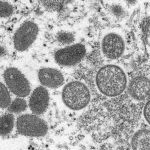 California man infected with COVID-19 and monkeypox