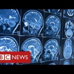 Covid survivors may face life-long brain injuries – BBC News